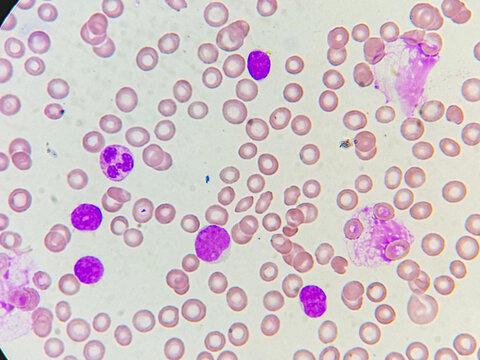 Acute leukemia. Microscopic image of complete blood cells. 