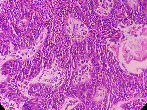 Tissue from left auricle. Carcinoma in situ with microinvasion. Histopathology microscopic image. 
