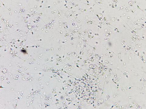 Sperm analysis on microscopic examination, Normozoospermia, normal semen analysis.