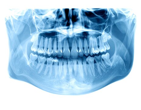 Dental X-ray showing teeth and bone structure in bluish tones, contrasted against a white background
