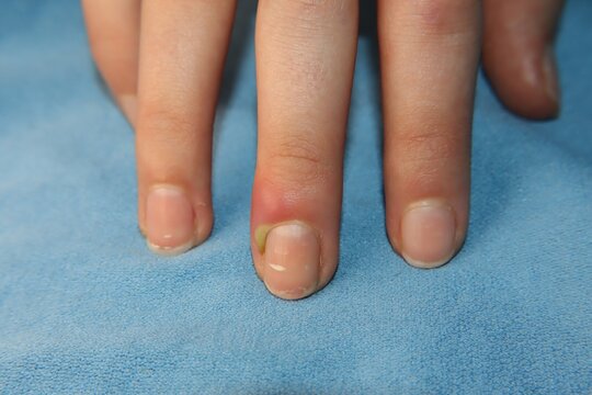 Closeup of acute paronychia on a fingernail with redness, swelling, and pus near the cuticle. Clinical detail highlights infection signs for medical education, dermatology references and healthcare.