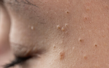 Fototapeta premium Acne on skin with pores and sebum. Closeup of acne with inflamed epidermis texture. Dermatology skincare for acne and irritation. Macro detail of acne with blemish.