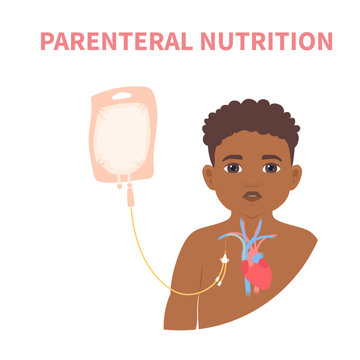 Young patient receiving parenteral nutrition through a central intravenous IV access. Clinical feeding therapy in critical care for malnourished pediatric patients in hospitals. Vector illustration.