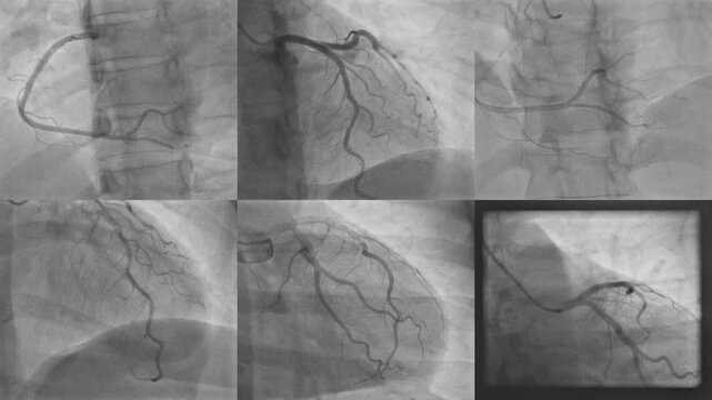 Normal coronary artery fluoroscopy angiography &ndash; cardiac catheterization imaging video