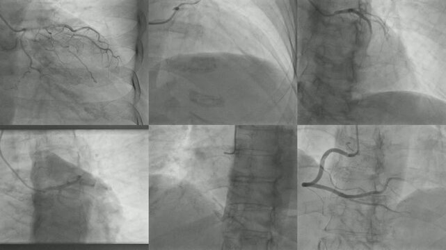 Medical Imaging of Coronary Arteries During Cardiac Catheterization