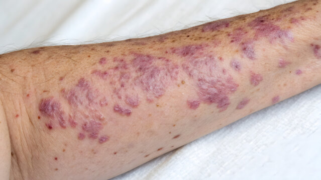 Close up view of human arm skin affected by lichen planus
