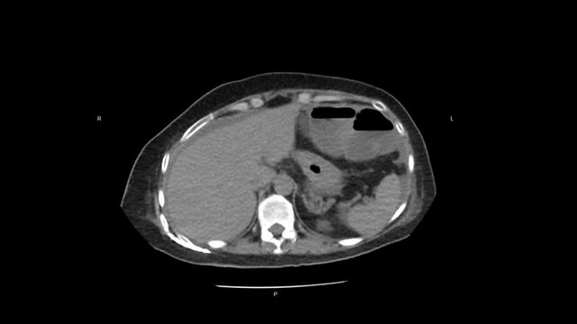 Multiplanar CT scan of the abdomen demonstrating sagittal, coronal, and axial reconstructions revealing ascites in the perihepatic and perisplenic spaces with minimal bilateral pleural effusion