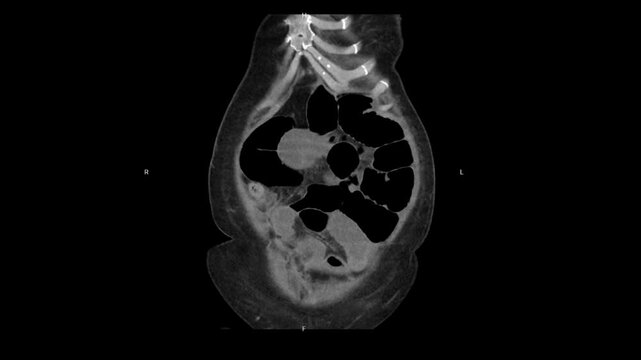 Multiplanar CT scan of the abdomen demonstrating sagittal, coronal, and axial reconstructions revealing ascites in the perihepatic and perisplenic spaces with minimal bilateral pleural effusion