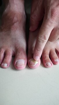 Close up of a man touching a damaged toenail with onychomycosis. Male finger pointing at a yellow unhealthy nail on a foot. Concept of dermatology, podiatry, nail dystrophy and fungal infection.