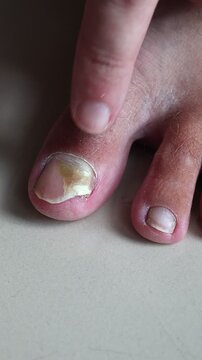Close up of a man touching a damaged toenail with onychomycosis. Male finger pointing at a yellow unhealthy nail on a foot. Concept of dermatology, podiatry, nail dystrophy and fungal infection.