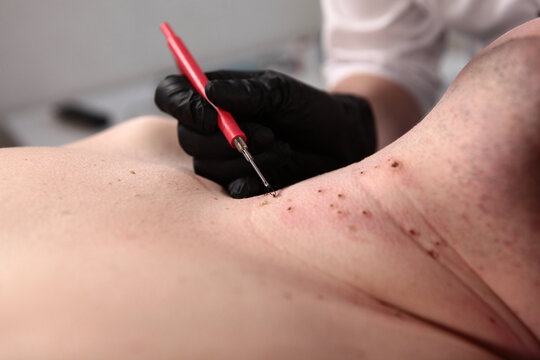 Removal of papillomas and moles. A surgeon removing many small papillomas with a laser on a man's body, burnt skin, close-up view.