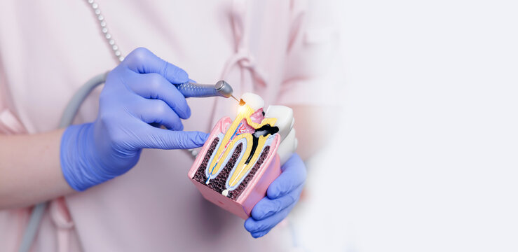 Gloved hands demonstrating dental procedure with drill treatment of caries and pulpitis of nerve canal on tooth model, banner stomatology dentistry with white light background