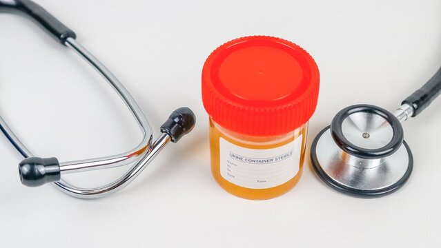 Sterile urine sample container and stethoscope on white background, medical diagnostic concept.