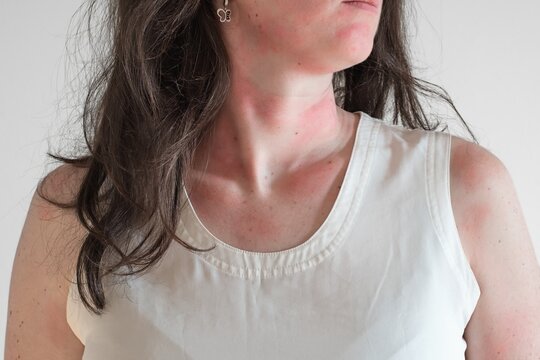 Allergic skin reaction on the female neck and face