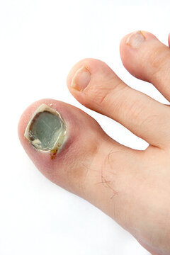 Injured big toe with subungual hematoma.