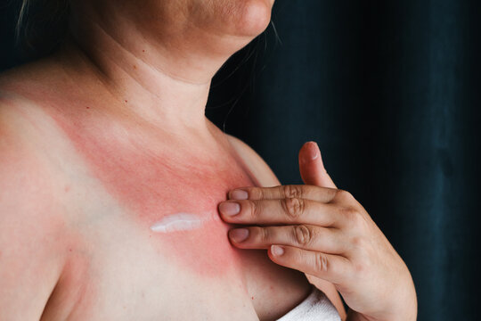 Unrecognizable woman applying soothing white cream to severe red sunburn on chest area. Skin care and treatment of solar dermatitis and UV damage.