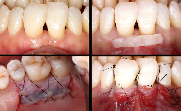 Soft tissue graft for jawbone resorption and gum recession in dentistry. Periodontal treatment involving dental grafts and gingival transplantation. dental treatment gum and implant