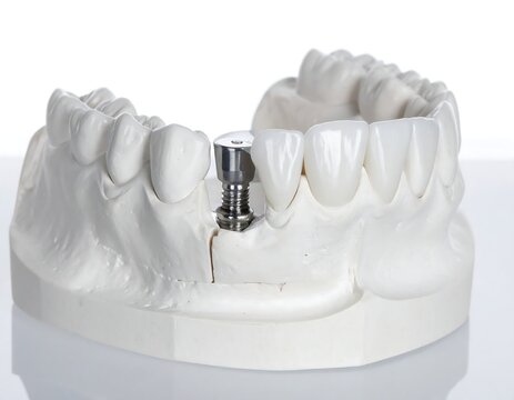 A dental model with a missing tooth replaced by a metal implant