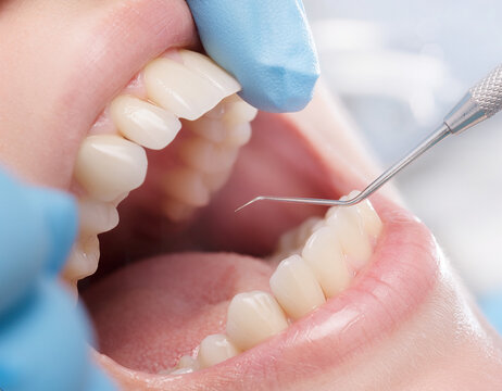 Dentist examining a patient&rsquo;s teeth with dental instruments in a clinic