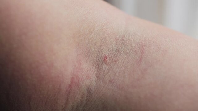 A close-up of a hand showing a small mark left after a blood sample was taken from a vein. The scene highlights the medical procedure and the moment after a routine test. High quality 4k footage