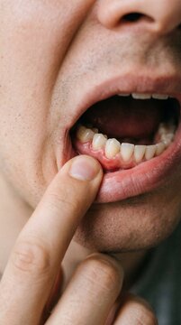 Hand Touching Inflamed Gum Showing Tooth Pain