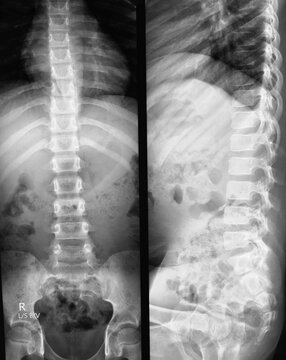 X-ray of the human lumbo sacral spine. Lumber lordosis is lost may be due to muscle spasm. 