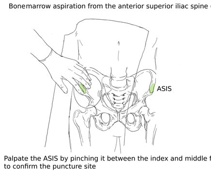 Bone marrow aspiration from the anterior superior iliac spine (ASIS)