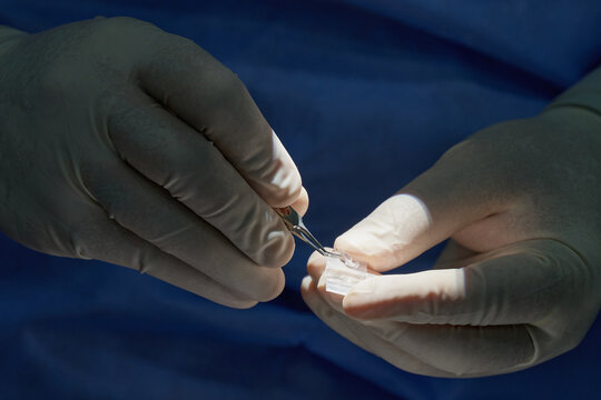 Ophthalmic surgeon holding intraocular lens with tweezers during eye surgery preparation, close-up of sterile medical procedure.