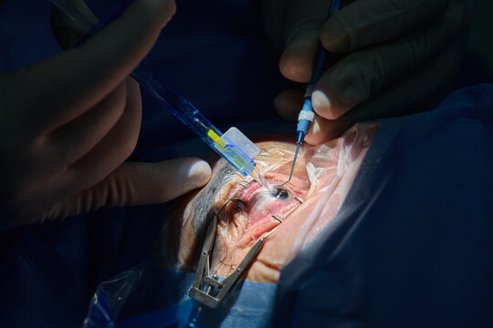 Ophthalmic surgeon performing cataract surgery with intraocular lens implantation, close-up of eye microsurgery in operating room.