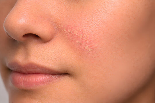 Photorealistic dermatology clinical close-up of the nasolabial fold area showing mild seborrheic dermatitis: subtle pink-red patch along the fold with fine slightly greasy scale