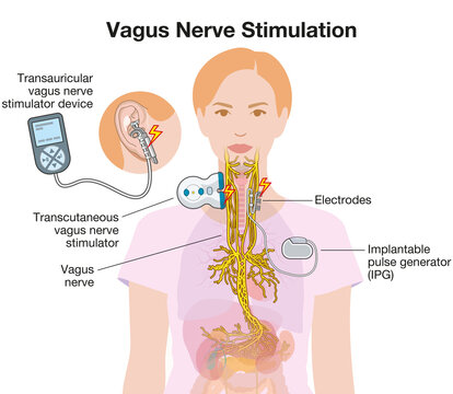Vagus Nerve Stimulation with Implant and Auricular Electrode. Labeled Illustration