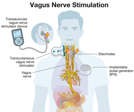 Vagus Nerve Stimulation with Implant and Auricular Electrode. Labeled Illustration