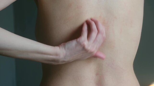 Woman with allergic skin reaction, dermatitis, or hives scratching her itchy back, which shows redness and irritation from dermatological problem caused by food or medicine. Woman with allergy symptom