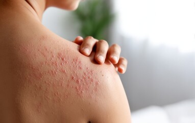 Naklejka premium Itchy Red Rash Covering the Upper Shoulder Area of a Person's Skin