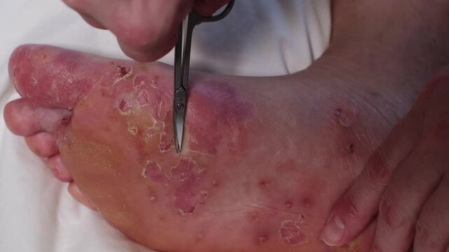 Close-up of a female foot with dry, peeling skin. Wound from blisters of eczema, allergic reaction or acute psoriasis. Careful removal of dead skin with a small scissors for treatment and foot hygiene