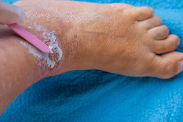 Fototapeta premium Applying medicated cream, ointment on irritated skin ankle, eczema treatment, dermatology care, chronic inflammation relief, doctor treats large healing wound, sores on limbs, tissue regeneration