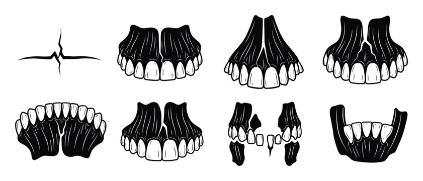 Dental surgery and jaw fracture collection showing broken teeth and maxillary trauma
