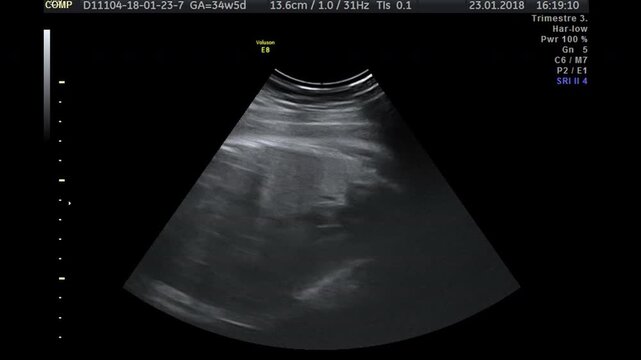 Ultrasound sonogram of fetus actively moving in womb closeup. Regular prenatal checkup services to control healthy development of baby