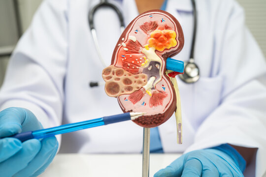 Kidney disease, Chronic kidney disease ckd, Doctor hold human model.
