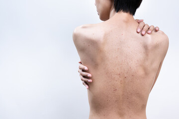 Naklejka premium Close-up of asian female touching their shoulder, showing back acne, blemishes, and uneven skin tone. Ideal for dermatology, body skincare, and health concepts.