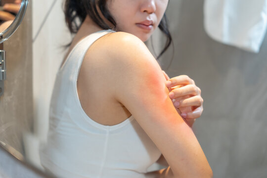 skin problem and beauty. Young woman scratch body has itchy skin from skin allergic, steroid allergy, sensitive skin, red from sunburn, chemical allergy, rash, insect bites, Seborrheic Dermatitis.