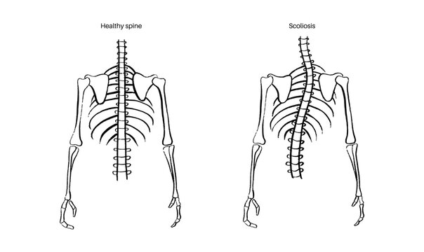 Scoliosis spine deformity