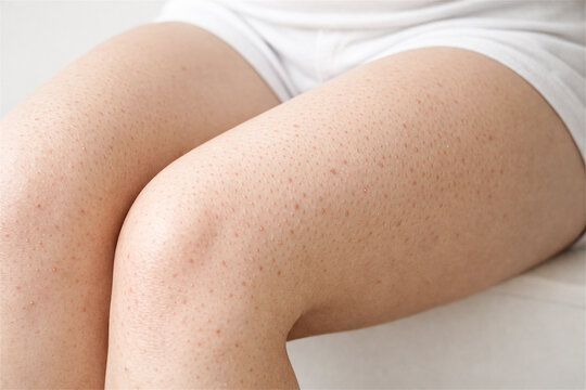 Woman showing skin with keratosis pilaris on leg. Strawberry legs condition with red bumps and irritation. Dermatology concept for body care, skincare treatment and beauty health.