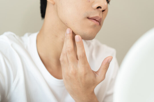 Asian men worry about acne on their faces when looking in the mirror
