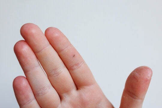 Close up of splinter in child finger with dry irritated skin dermatology concept