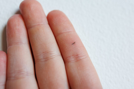 Macro view of small splinter in child finger skin medical dermatology problem