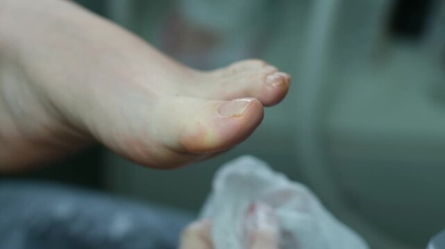 Close-up removal of calluses on the foot using a medical instrument. Treatment of diseases, defects, calluses on women's feet in a podiatry and pedicure salon. High quality 4k footage
