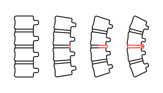 Spinal disc herniation, pain with bending of vertebrae bone, line icons. Orthopedic medical, degenerative disc disease. Healthcare concept, spine anatomy. Vector illustration