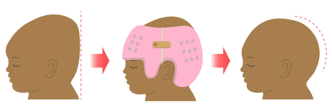 Before and after comparison diagram showing infant cranial correction with helmet therapy