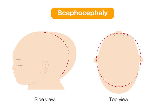 babies with plagiocephaly, brachycephaly, and dolichocephaly showing head shape deformities, top and side view